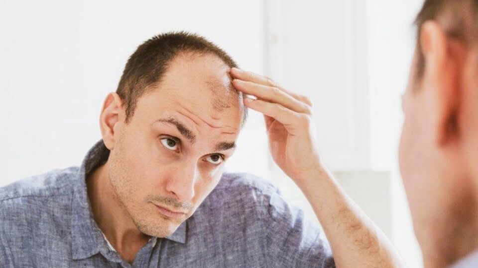 Managing Your Hair Loss
