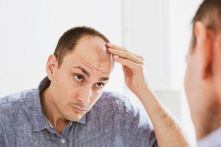 Managing Your Hair Loss